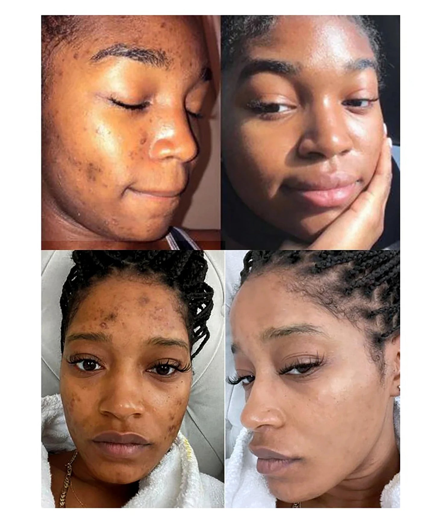 AILKE Brightening Skin Care Set, Reduce Dark Spots, Acne, Moisturizing, Nourishing and Smooth Skin, Non-Greasy, Absorb Instantly